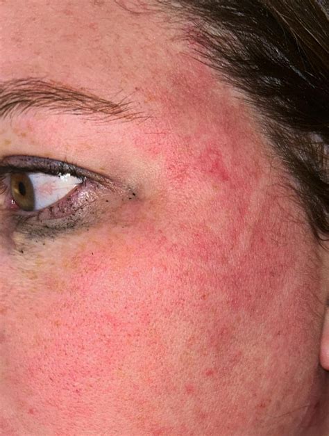 awaiting ms results skin rash rdermatologyquestions