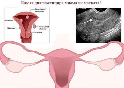 Как се диагностицира миома на матката? - ArsMedica.bg | Fashion, Women ...