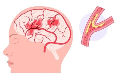 transient ischaemic attack tia    mini stroke bhf