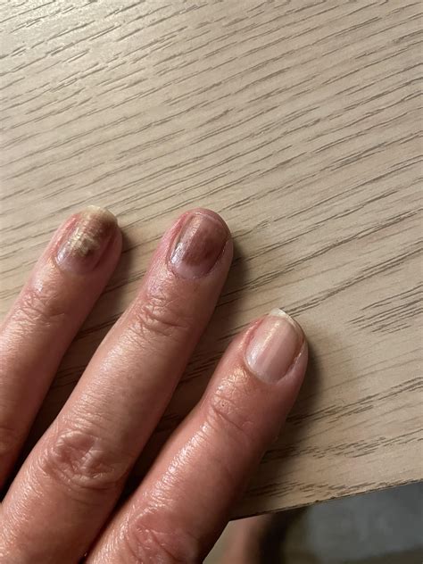Psoriatic nails or fungus? : r/NailFungus