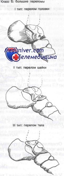 Большие переломы таранной кости (голоки, шейки, тела). Диагностика и ...
