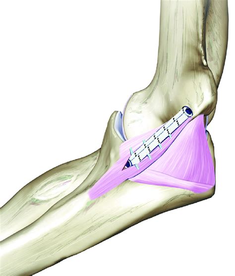 Ulnar Collateral Ligament Repair With Internal Bracin - vrogue.co