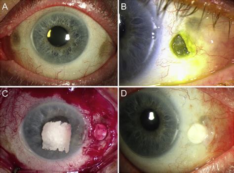 Senile Scleral Plaque Crosstalk Between Myopia And Inflammation: A