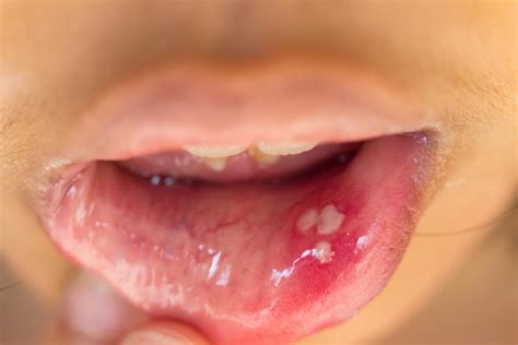 Hpv Bolinhas Na Língua