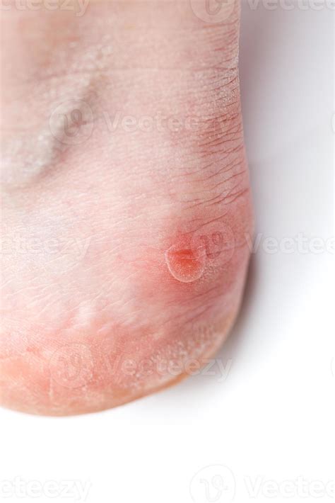 Small unpopped blister on heel, isolated on white background, close-up