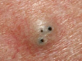 Sebaceous Cyst or Epidermoid In-office Treatment and Removal | Cyst Surgeon