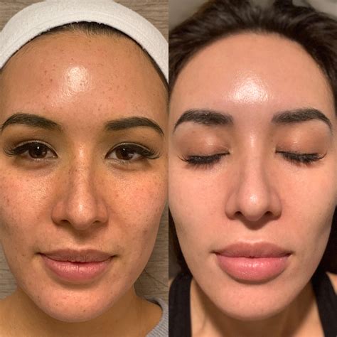 How To Treat Hydroquinone Damaged Skin? - GA Fashion
