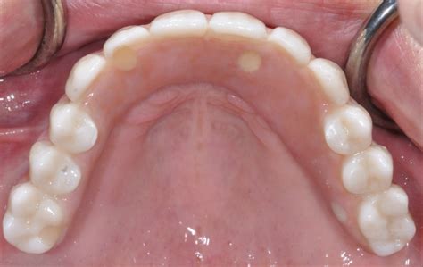Upper All on Four - Case 2 — Puget Sound Periodontics | Thomas Kang DDS