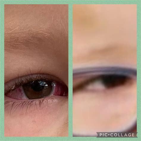Squint correction surgery as an adult | Mumsnet