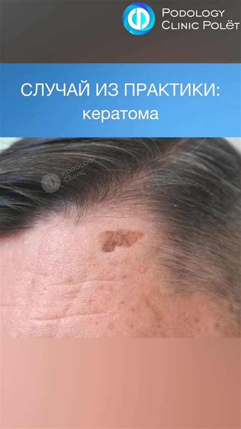 КЛИНИКА ПОДОЛОГИИ ПОЛЁТ | СЛУЧАЙ ИЗ ПРАКТИКИ: удаление кератомы ...