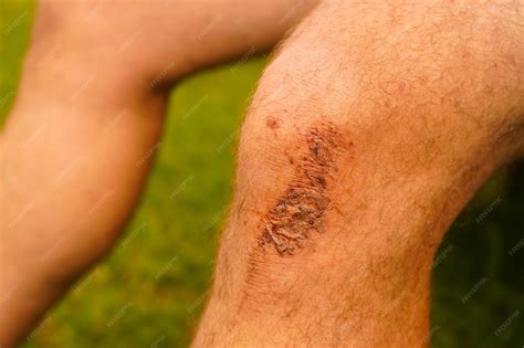 premium photo abrasion   knee  falling   ground people