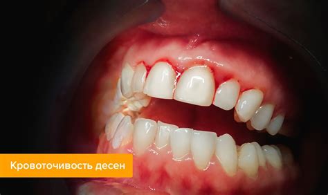 Кровоточат десны — что делать в статье экспертного журнала о ...