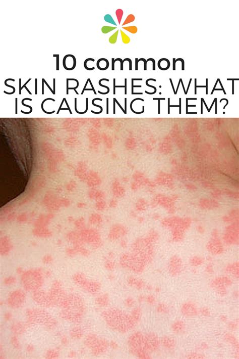 10 Most Common Types Of Skin Rashes Daily Health Valley | Images and ...