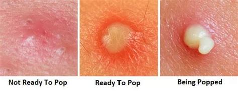 5 Signs That Say "Leave It Alone: When To Resist The Urge To Pop That Pimple