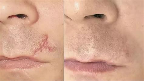 Рубцы кожи лица – Физиотерапевтические процедуры при келоидных рубцах