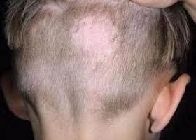 Грибок на голове: фото, симптомы, лечение грибковых заболеваний кожи ...