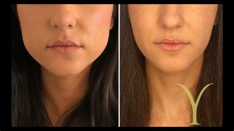 Botox Para Bruxismo Antes E Depois - 😱 [BRUXISMO] y como COMBATIRLO de forma definitiva. Tratamiento con ...