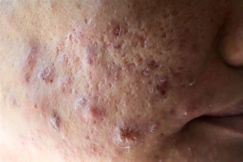 nodular acne
