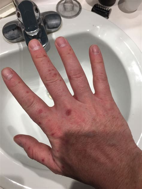Coxsackie (hand foot and mouth disease) | saddlehunter.com