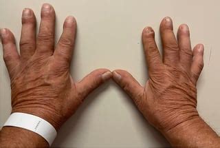 Pierre-Marie Bamberger Syndrome Leading to the Diagnosis and Surgical ...