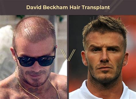 Hair Implants Celebrities at Dennis Marquis blog