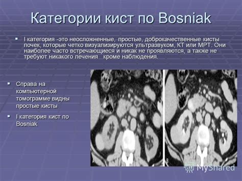 Презентация на тему: "Классификация кист почек по Bosniak M.A. (The ...