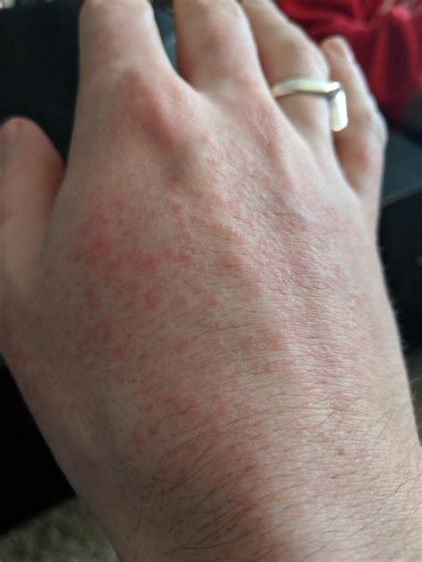 Rash On Hands