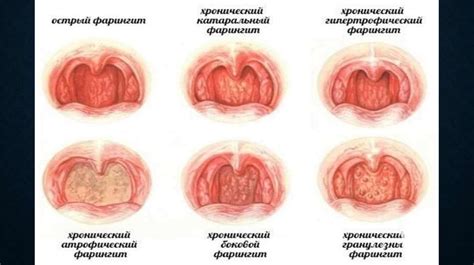 Фарингиты - online presentation
