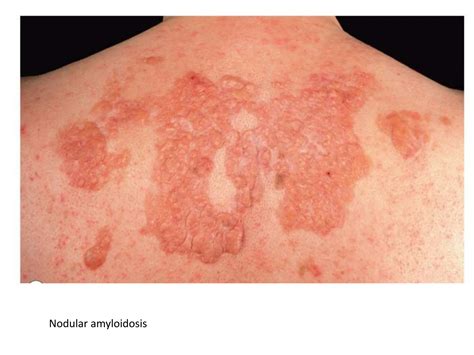 Cutaneous amyloidosis by dermatology resident.pptx