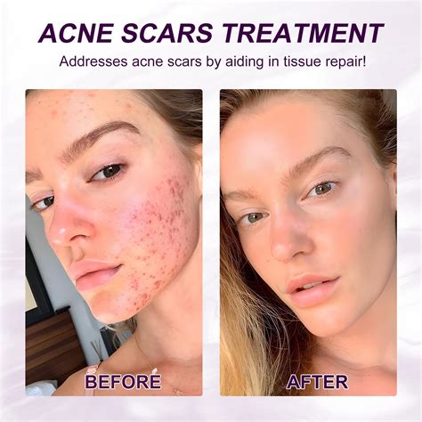 Azelaic Acid Before And After Azelaic Acid Anti Acne Gel Melasma