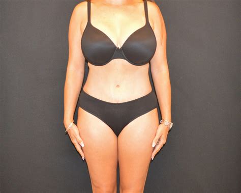 Case 10615 - Tummy Tuck Revision Before and After Photo Gallery