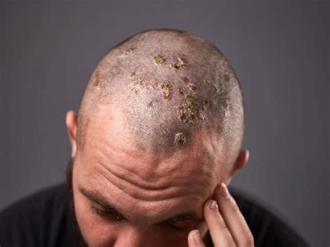 What Is Black Fungus? Its Causes, Symptoms & Risks - TV Health