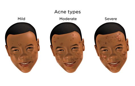 Moderate Acne | My Doctor Online