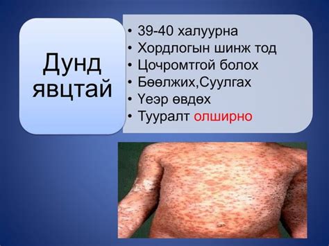 гар, хөл, амны өвчин | PPT