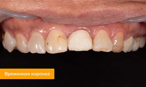 Пластмассовые коронки на зубы – цена, отзывы, фото, этапы установки ...