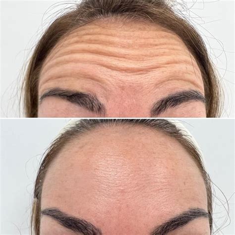 Botox: Antes e depois em 20 Fotos | Botox, Aesthetic