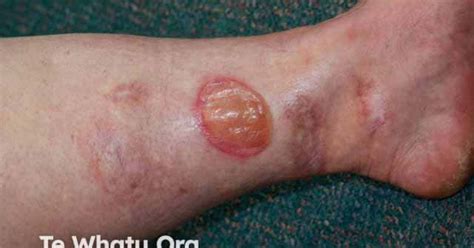 Pyoderma gangrenosum image