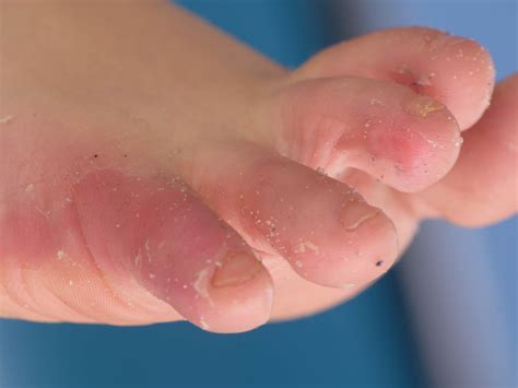 Acral Peeling Skin Syndrome Peeling Fingertips: Causes & Treatment
