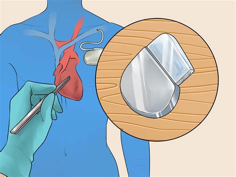 How To Stop Tachycardia Attack at Janita Huang blog