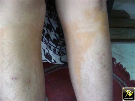 Cyanose - DermatoMaroc