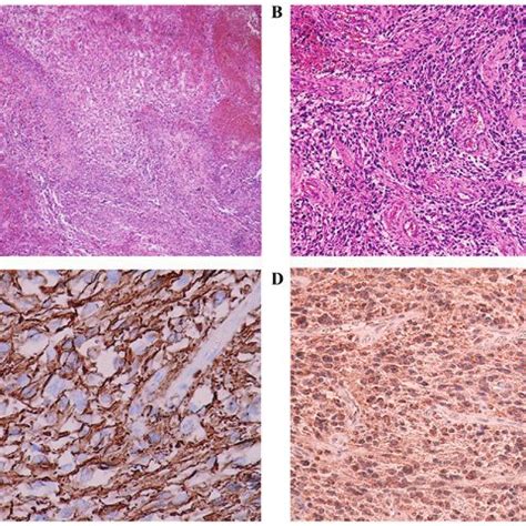 Histology of the tumor. (A) The tumor exhibited pseudopalisading ...