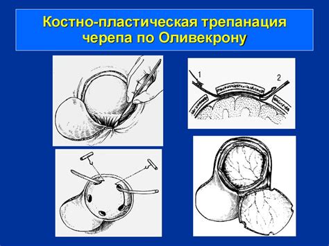 Операции на мозговом отделе головы - презентация онлайн