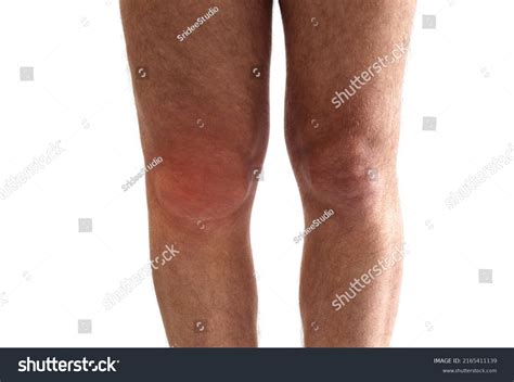 647 Knee fluid Images, Stock Photos & Vectors | Shutterstock