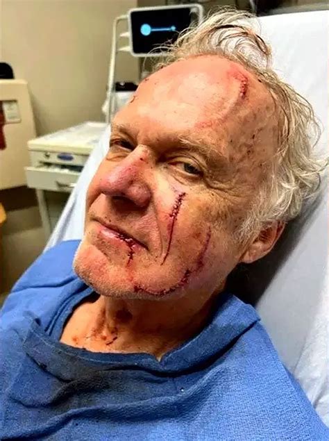 Grisly photos show North Carolina bear-attack injuries