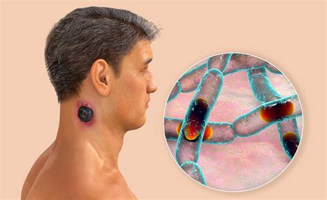 Anthrax Virus Symptoms