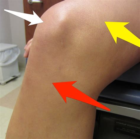 Knee Injuries: Fall On Knee Injuries