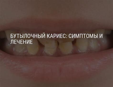 Бутылочный кариес у детей: причины, симптомы и лечение