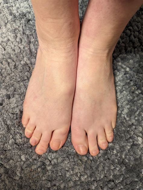 Bump on top of foot : r/medical_advice