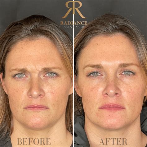 Frownlines Treatment Before and After Images | Bothell, WA