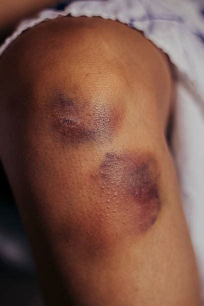 2,000+ Scraped Knee Stock Photos, Pictures & Royalty-Free Images - iStock